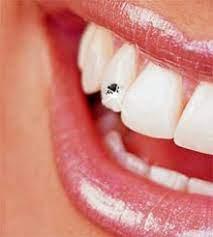 Kit dental temporal – Crystal Nails
